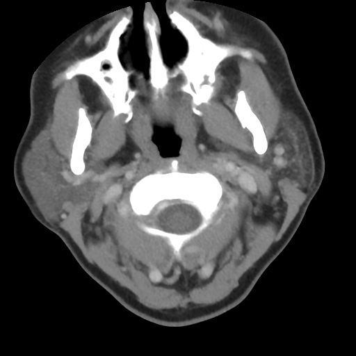 File:Carotid body tumor (paraganglioma) (Radiopaedia 38586-40729 A 10).jpg