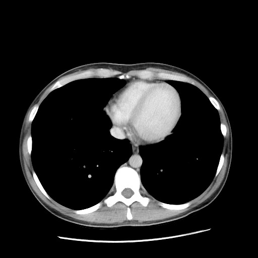 File:Castleman disease with fibrous pseudotumor in the abdomen (Radiopaedia 77296-89373 A 4).jpg