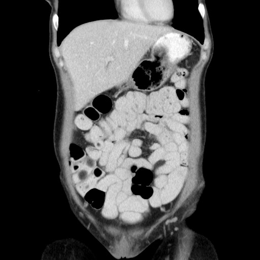 Castleman disease with fibrous pseudotumor in the abdomen (Radiopaedia 77296-89373 B 24).jpg