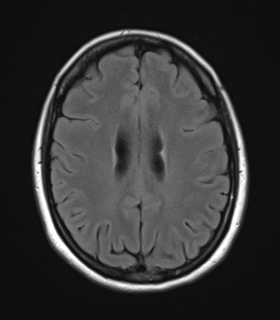 File:Cavernoma with bleed - midbrain (Radiopaedia 54546-60774 Axial FLAIR 21).png