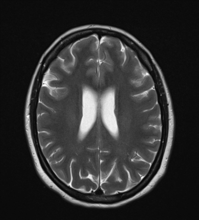 File:Cavernoma with bleed - midbrain (Radiopaedia 54546-60774 Axial T2 18).png