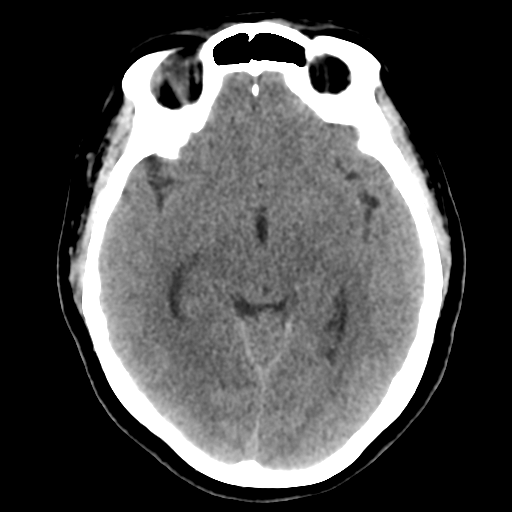 Cavernoma with hemorrhage (Radiopaedia 70755-80931 Axial non-contrast 24).png