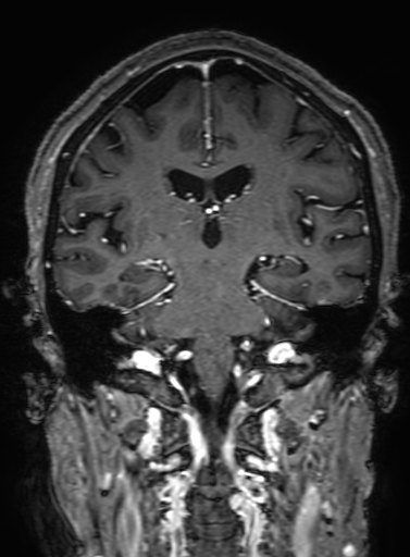 Cavernous hemangioma of the cerebellar falx (Radiopaedia 73025-83724 Coronal T1 C+ 214).jpg