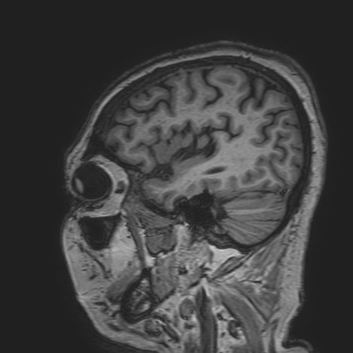 File:Cavernous hemangioma of the cerebellar falx (Radiopaedia 73025-83724 Sagittal T1 50).jpg