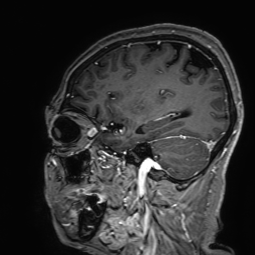 Cavernous hemangioma of the cerebellar falx (Radiopaedia 73025-83724 Sagittal T1 C+ 153).jpg