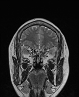 File:Cavernous sinus meningioma (Radiopaedia 63682-72367 Coronal T2 1).jpg