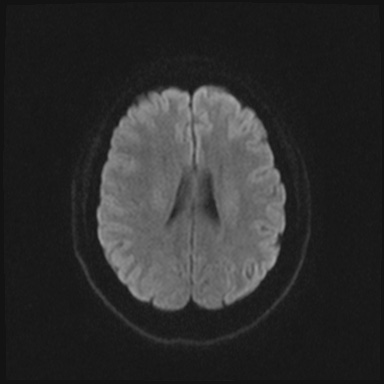 File:Cavernous sinus meningioma (Radiopaedia 63682-72367 DWI 55).jpg