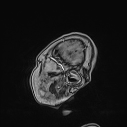 Cavernous sinus meningioma (Radiopaedia 63682-72367 Sagittal T1 C+ 22).jpg