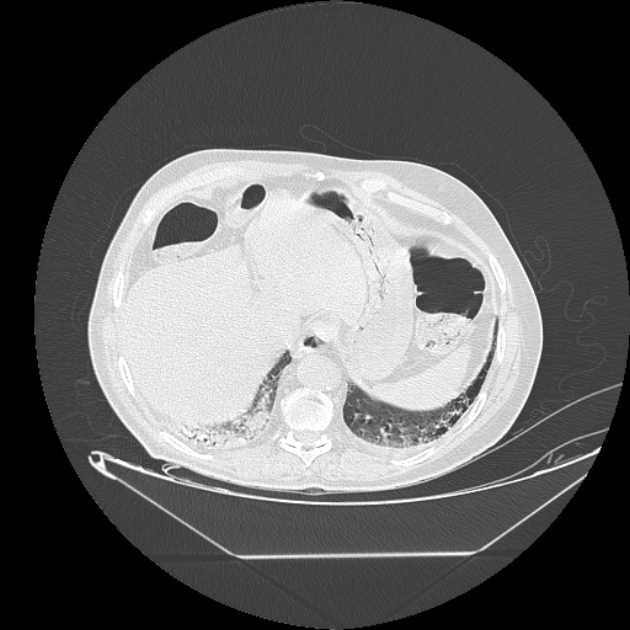 Cavitating bronchogenic carcinoma (Radiopaedia 44489-48162 Axial lung window 75).jpg