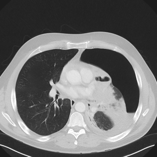 Cavitating pneumonia complicated by pneumothorax (Radiopaedia 48149-52994 Axial lung window 36).png