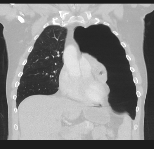 Cavitating pneumonia complicated by pneumothorax (Radiopaedia 48149-52994 Coronal lung window 22).png