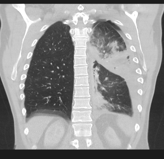 Cavitating pneumonia complicated by pneumothorax (Radiopaedia 48149-52994 Coronal lung window 43).png