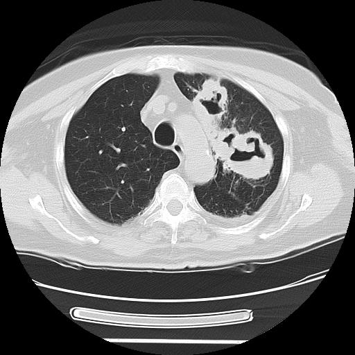 Cavitating pulmonary metastases (Radiopaedia 89545-106544 Axial lung window 16).jpg