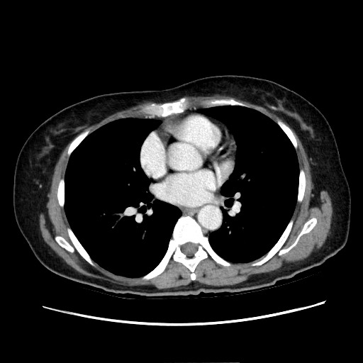 Cecal adenocarcinoma (Radiopaedia 75909-87331 A 3).jpg