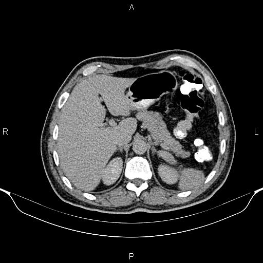 File:Cecal adenocarcinoma (Radiopaedia 85324-100916 Axial C+ delayed 23).jpg