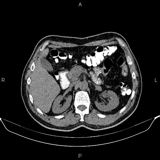 Cecal adenocarcinoma (Radiopaedia 85324-100916 Axial non-contrast 30).jpg