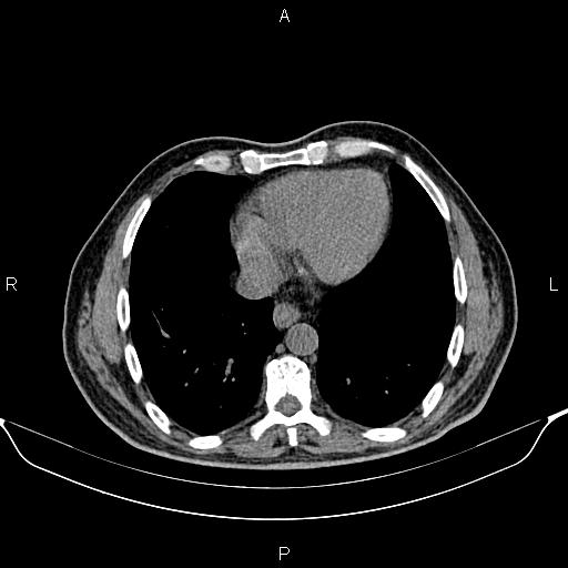 File:Cecal adenocarcinoma (Radiopaedia 85324-100916 Axial non-contrast 5).jpg