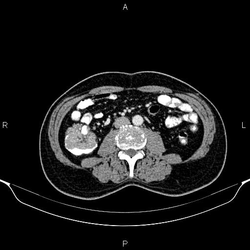 Cecal adenocarcinoma (Radiopaedia 85324-100916 B 51).jpg