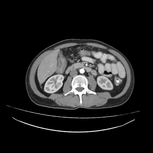 Cecal carcinoma with local lymphadenopathy (Radiopaedia 31428-32240 A 24).jpg