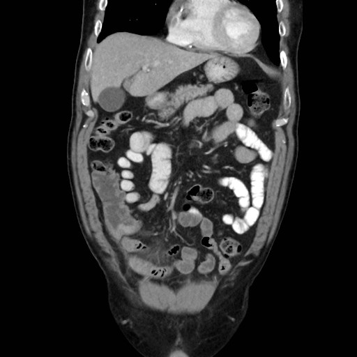 Cecal mass causing appendicitis (Radiopaedia 59207-66531 B 16).jpg