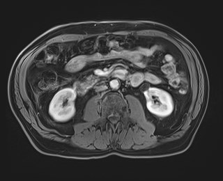 Cecal mass causing appendicitis (Radiopaedia 59207-66532 T1 C+ PV phase 68).jpg