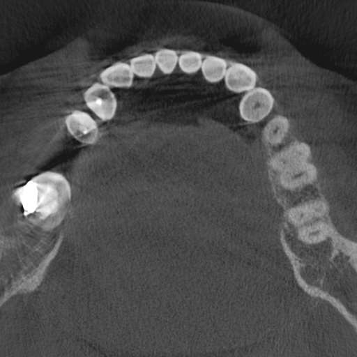 Cemento-osseous dysplasia (Radiopaedia 48251-53126 Axial non-contrast 55).jpg