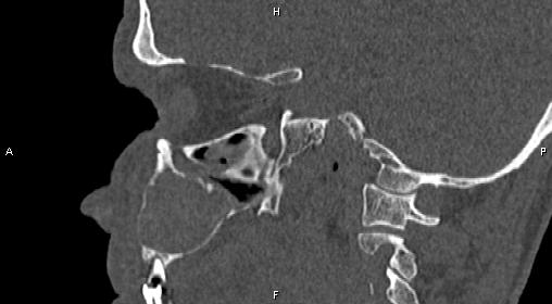 File:Central giant cell granuloma (Radiopaedia 83346-97761 Sagittal bone window 19).jpg