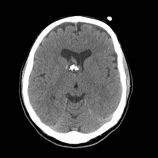 Central neurocytoma (Radiopaedia 68725-78432 Axial non-contrast 24).jpg