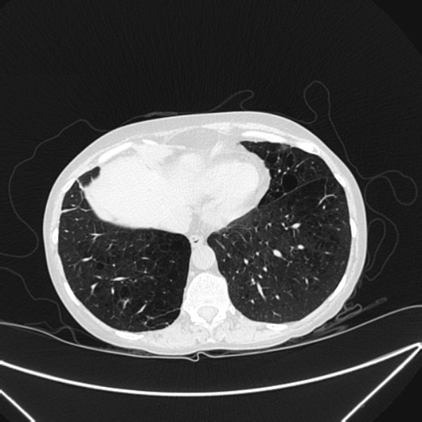 Centrilobular pulmonary emphysema (Radiopaedia 24495-24789 Axial lung window 75).jpg
