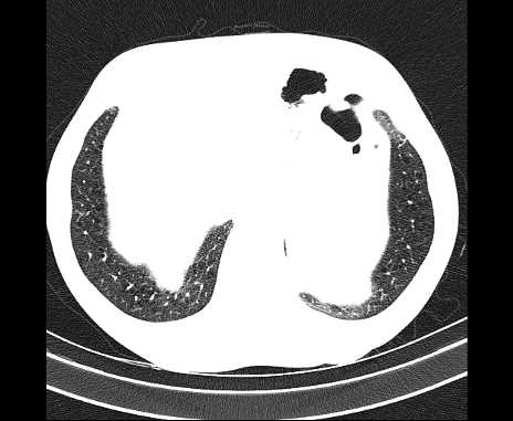 Centrilobular pulmonary emphysema (Radiopaedia 62468-70718 Axial lung window 69).jpg