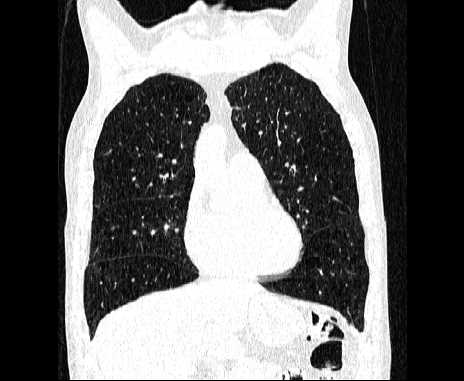 Centrilobular pulmonary emphysema (Radiopaedia 62468-70718 Coronal lung window 23).jpg