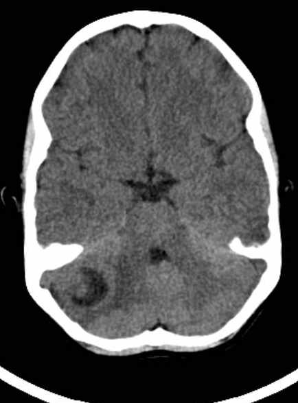 File:Cerebellar abscess (Radiopaedia 73727-84527 Axial non-contrast 31).jpg