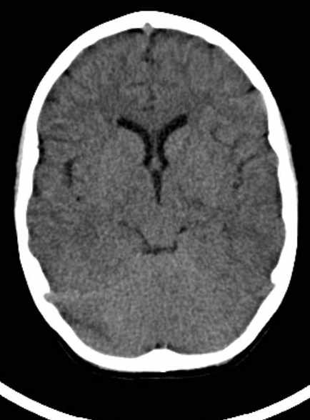 Cerebellar abscess (Radiopaedia 73727-84527 Axial non-contrast 36).jpg
