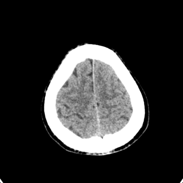 Cerebellar abscess secondary to mastoiditis (Radiopaedia 26284-26412 Axial non-contrast 139).jpg