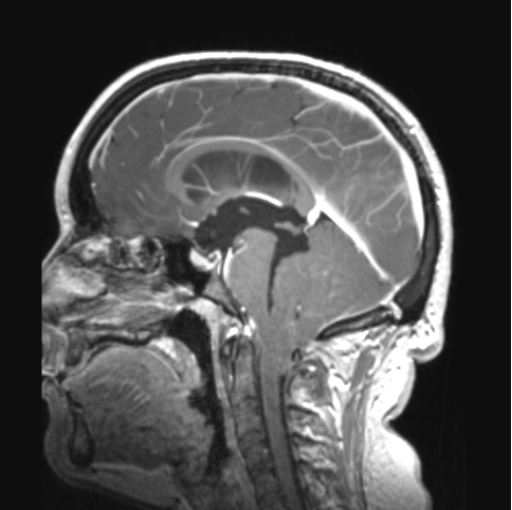 Cerebellar ependymoma complicated by post-operative subdural hematoma (Radiopaedia 83322-97736 Coronal T1 C+ 59).png
