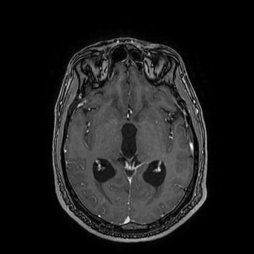 File:Cerebellar hemangioblastoma (Radiopaedia 88055-104622 Axial T1 C+ 92).jpg