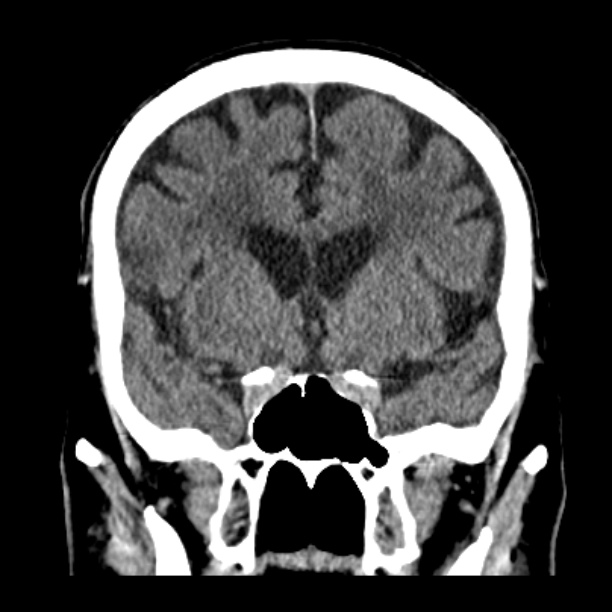 Cerebellar hemorrhage (Radiopaedia 27193-27359 Coronal non-contrast 23).jpg