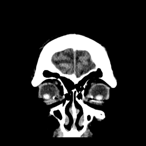 Cerebellar hemorrhage (Radiopaedia 27193-27359 Coronal non-contrast 8).jpg