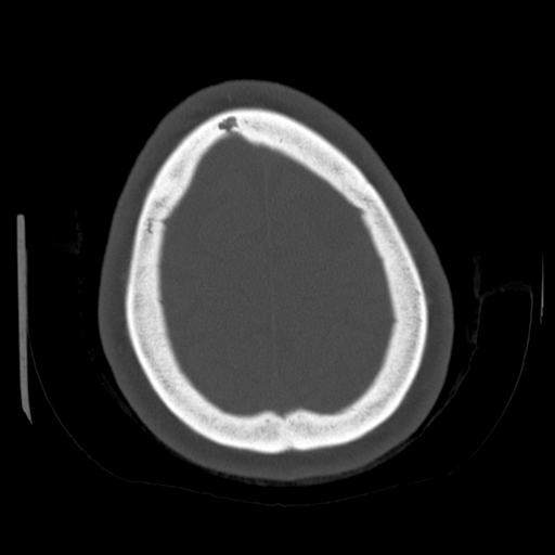 Cerebellar metastasis (cystic appearance) (Radiopaedia 41395-44258 Axial bone window 61).png