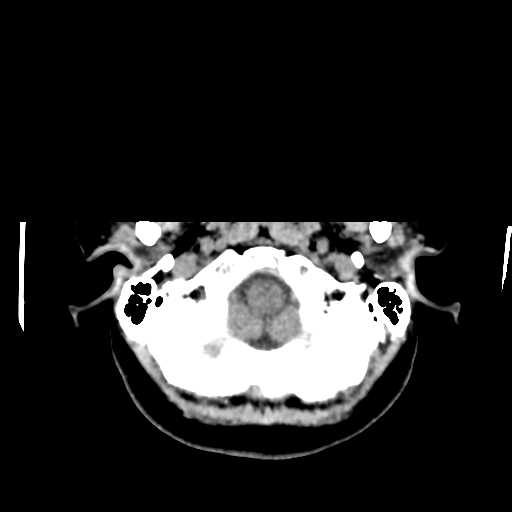 Cerebellar metastasis (cystic appearance) (Radiopaedia 41395-44258 Axial non-contrast 7).png