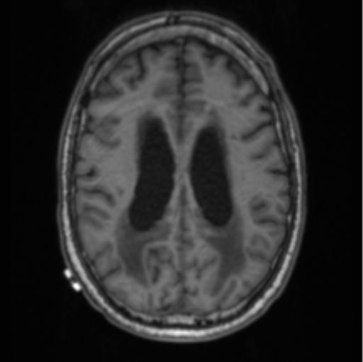 File:Cerebellar metastasis from lung adenocarcinoma (Radiopaedia 86690-102829 Axial T1 54).png