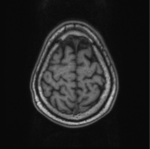 Cerebellar metastasis from lung adenocarcinoma (Radiopaedia 86690-102829 Axial T1 69).png