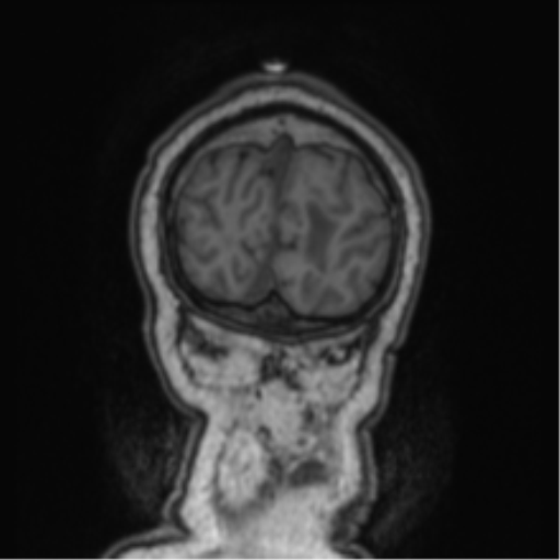 Cerebellar metastasis from lung adenocarcinoma (Radiopaedia 86690-102829 Coronal T1 10).png