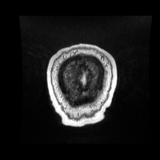 Cerebellar metastasis of pulmonary adenocarcinoma, cavernous venous malformation, and developmental venous anomaly (Radiopaedia 85827-101661 Coronal T1 C+ 12).jpg