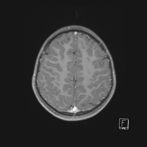 Cerebellar stroke (Radiopaedia 32202-33150 Axial T1 C+ 54).png
