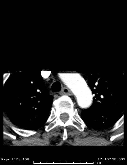 Cerebellar strokes due to intracranial giant cell arteritis (Radiopaedia 68799-78510 CT angiogram 157).jpg
