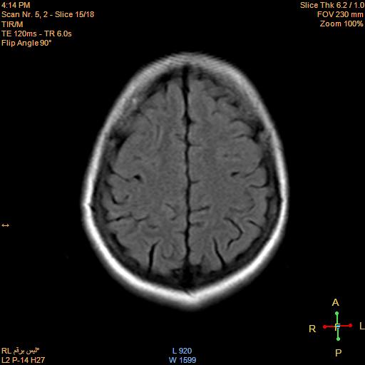 File:Cerebellopontine angle meningioma (Radiopaedia 22488-22525 Axial FLAIR 14).jpg
