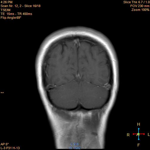 File:Cerebellopontine angle meningioma (Radiopaedia 22488-22525 Coronal T1 C+ 16).jpg