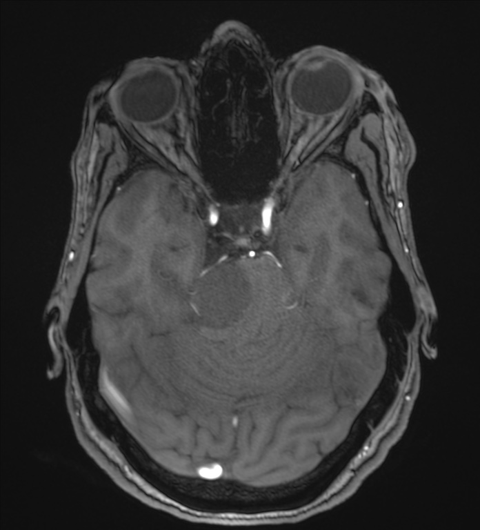 Cerebellopontine angle meningioma (Radiopaedia 72983-83680 Axial MRA 41).jpg