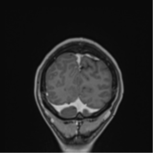 File:Cerebral abscess (Radiopaedia 60342-68009 H 1).png